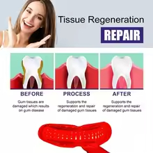 Teeth Whitening Laser Treatment - การรักษาโรคปริทันต์ด้วยเลเซอร์ - โรคปริทันต์อักเสบและโรคเหงือกอักเสบ - อุปกรณ์ทันตกรรม