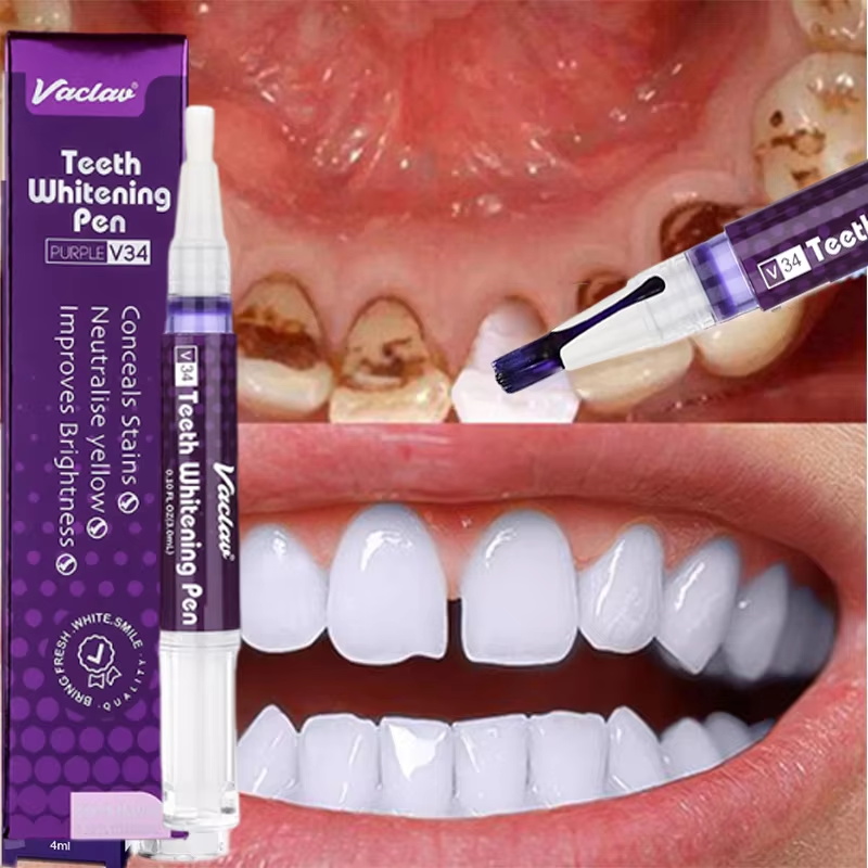 Whitening Pen Bleach - V34 ปากกาฟอกสีฟันยาสีฟันขจัดคราบจุลินทรีย์ทำความสะอาดสุขอนามัยช่องปากฟอกสีฟันเครื่องมือทันตกรรมลมหายใจสดชื่นการดูแลฟัน