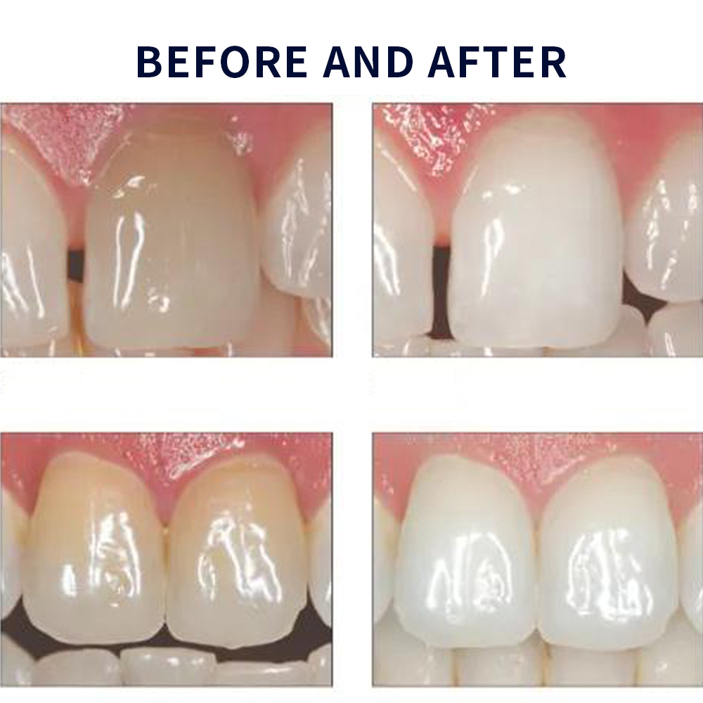 20% pF 20 16ชุดเจล8x1.2มล. ชุด - Teeth Whitening Home Kit บทวิจารณ์และราคา