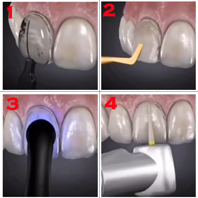แม่พิมพ์ฟันสำหรับวีเนียร์เรซิน - Teeth Whitening Lab บทวิจารณ์และราคา