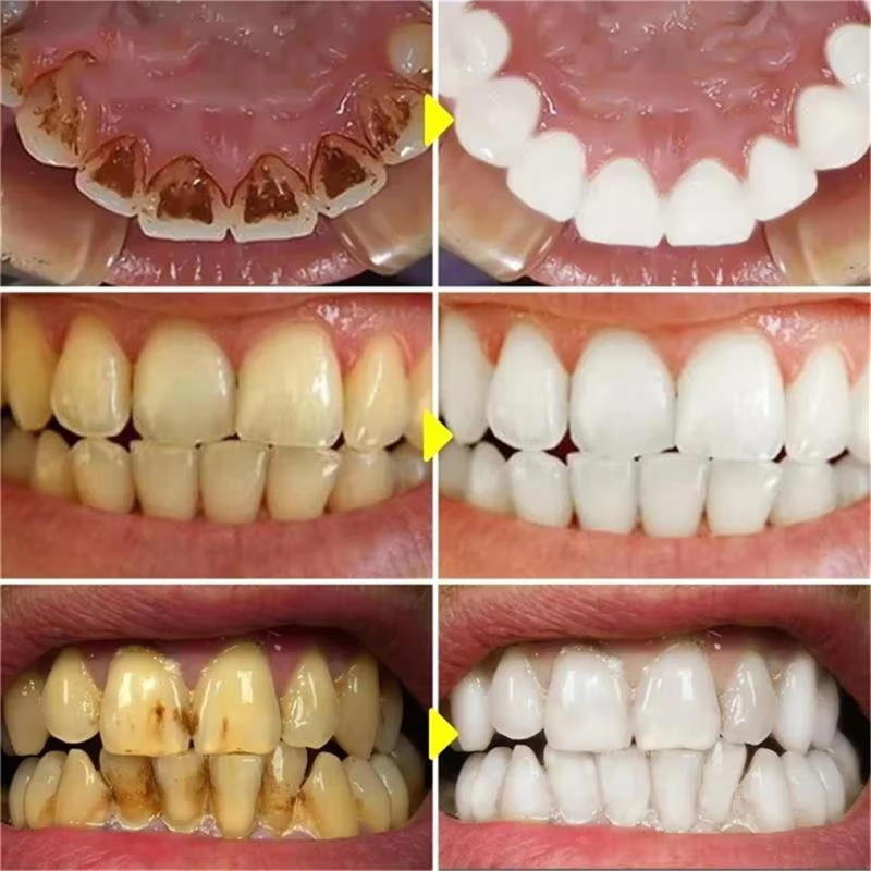 V34 ปากกาฟอกสีฟันยาสีฟันขจัดคร - Whitening Pen Bleach บทวิจารณ์และราคา