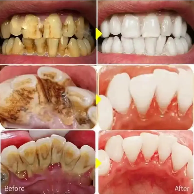 หัวขัดฟันอัลตราโซนิก P4 สำหรับ - Teeth Whitening Tips บทวิจารณ์และราคา