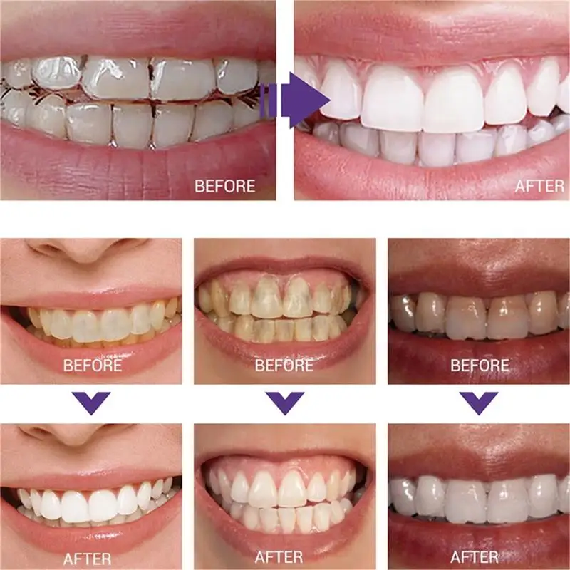 หัวขัดฟันอัลตราโซนิก P4 สำหรับ - Teeth Whitening Tips บทวิจารณ์และราคา